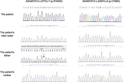 Hereditary Thrombotic Thrombocytopenic Purpura in a Chinese Boy With a Novel Compound Heterozygous Mutation of the ADAMTS13 Gene